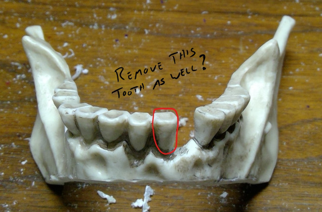 Remove another tooth?